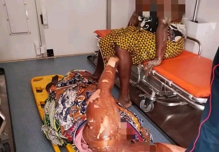 Côte d'Ivoire : Abobo, plusieurs personnes brûlées après une fuite enflammée de gaz