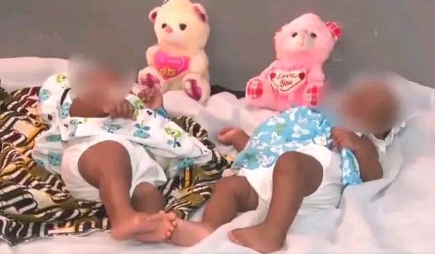 Burkina Faso : Bobo Dioulasso, deux jumelles siamoises opérées avec succès à l’hôpital Sourou Sanon