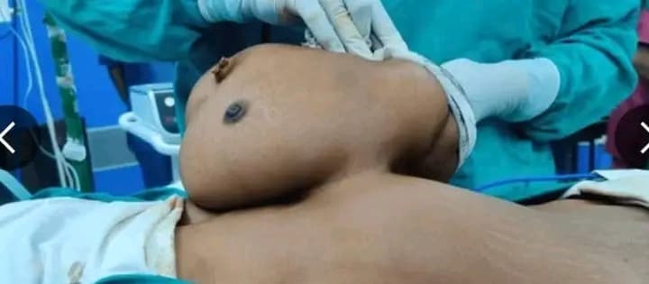 Inde : Une mère de 4 ans enlève son jumeau parasite à 47 ans