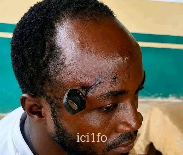 Ghana : Un homme reçoit une clé de moto dans le crâne en voulant séparer une bagarre entre deux Okada 