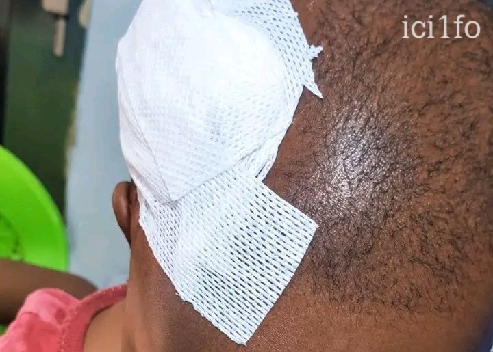 Guinée : Un chimpanzé arrache un bébé d’un an au dos de son frère et le mord à la tête